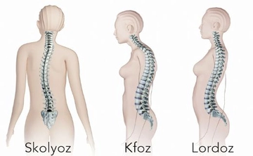 Kifoz Skolyoz Belirtileri ve Tedavisi