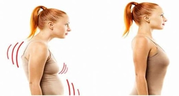 Kifoz Sporla Düzelir mi?